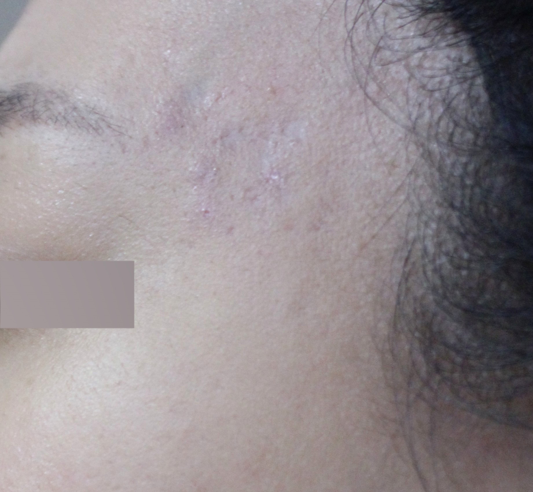 부산여드름흉터치료 듀얼테라피 후