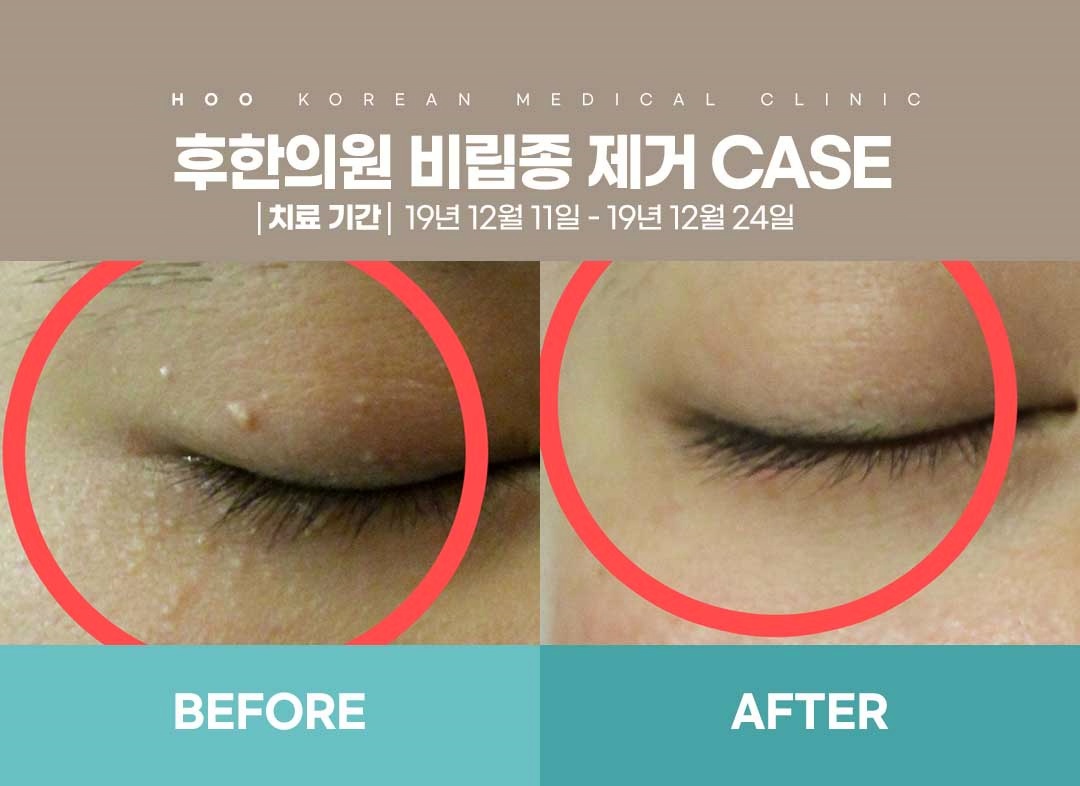 부산잡티제거 비립종 전후