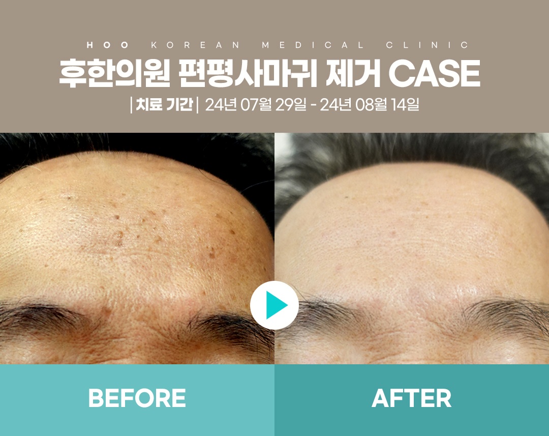 부산잡티제거 편평사마귀 전후