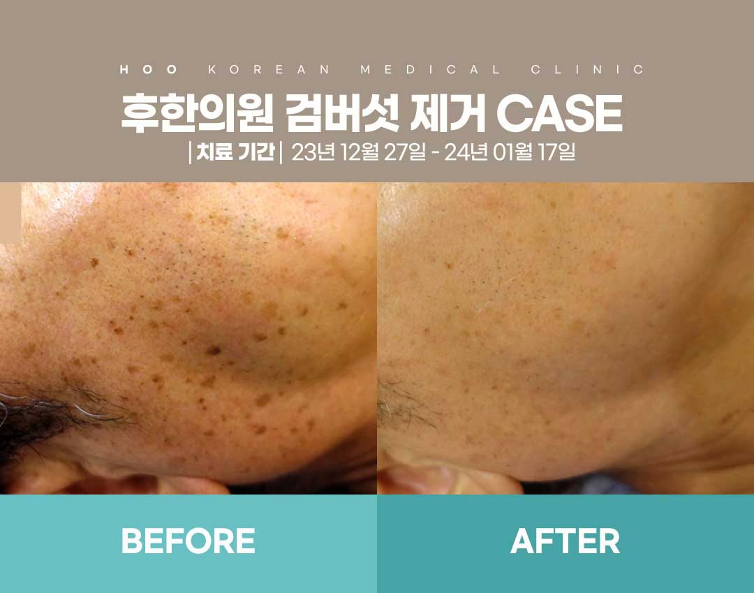 부산잡티제거 검버섯 전후