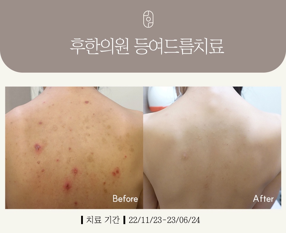 부산등여드름치료 후 깨끗해진 모습