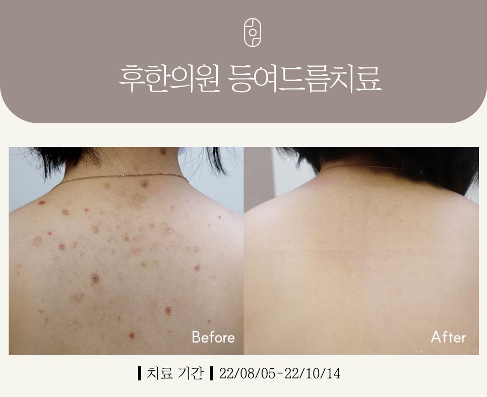 부산등여드름치료 색소침착 개선