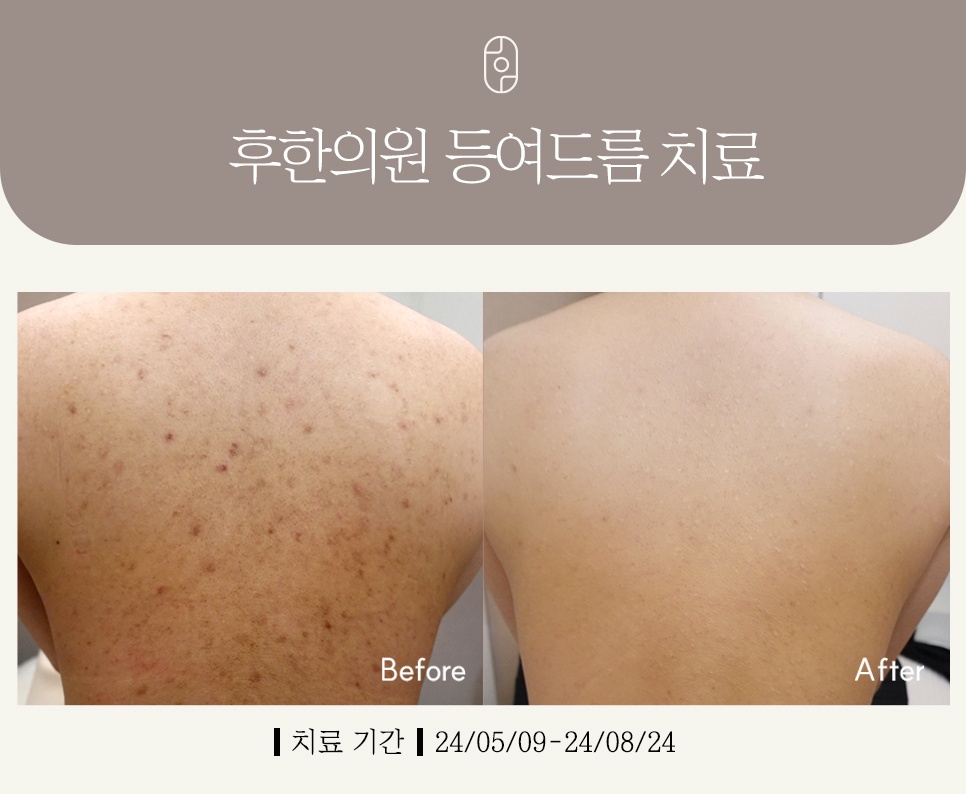 부산등여드름치료 후 변화된 모습