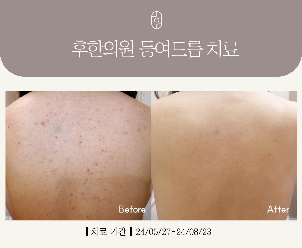부산등여드름치료 염증 개선
