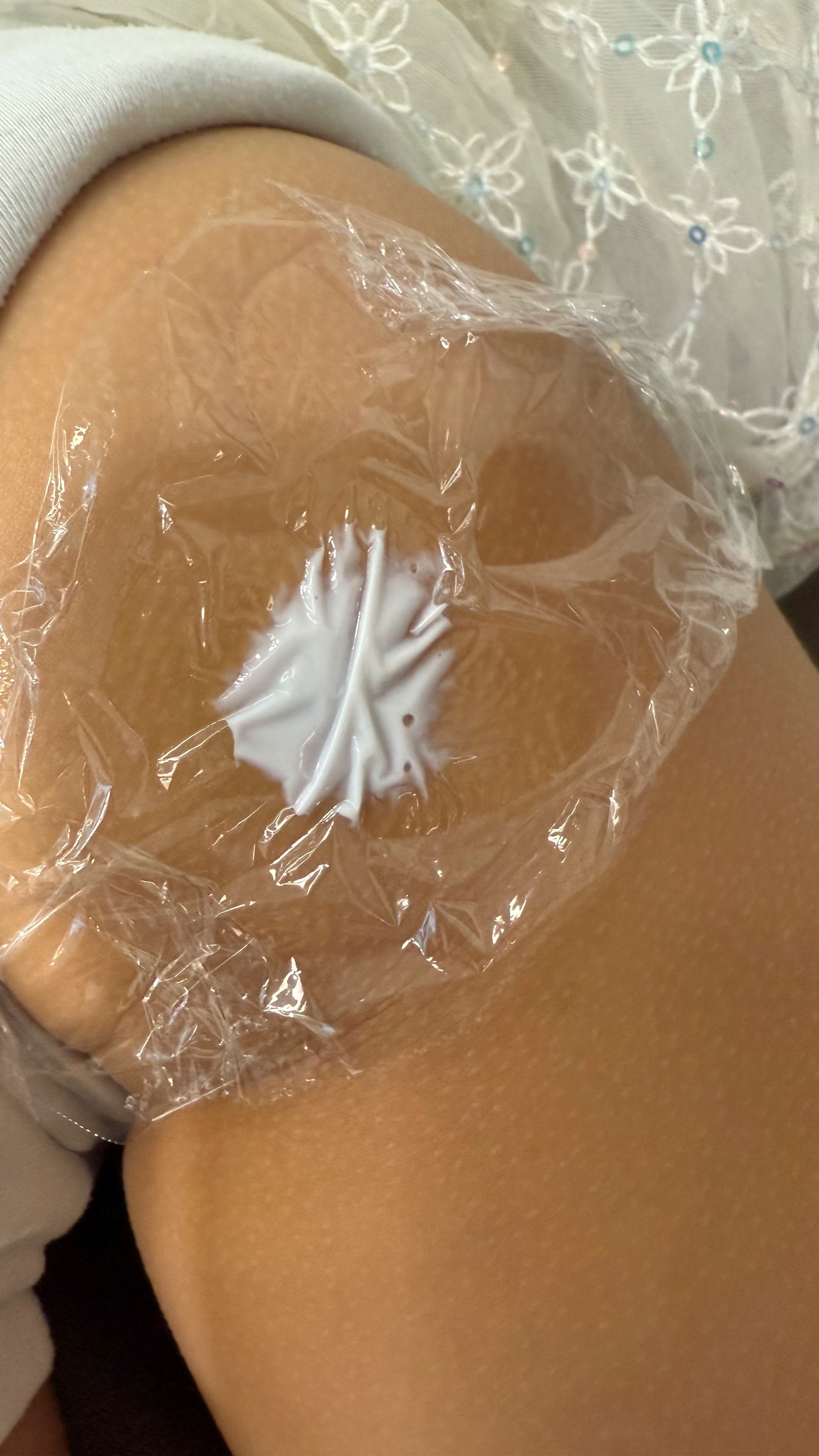 부산점빼기 마취 단계
