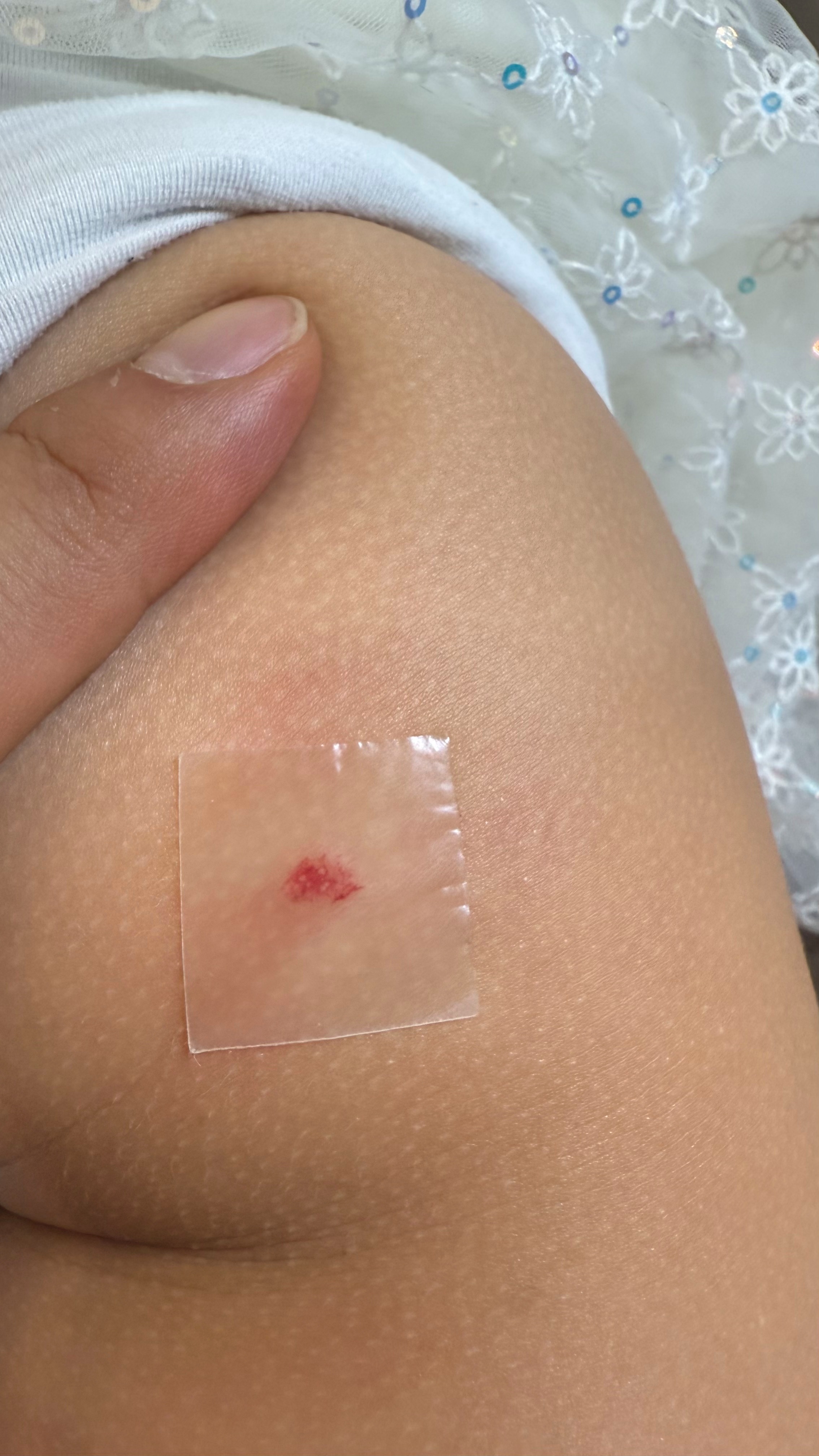 부산점빼기 회복 단계
