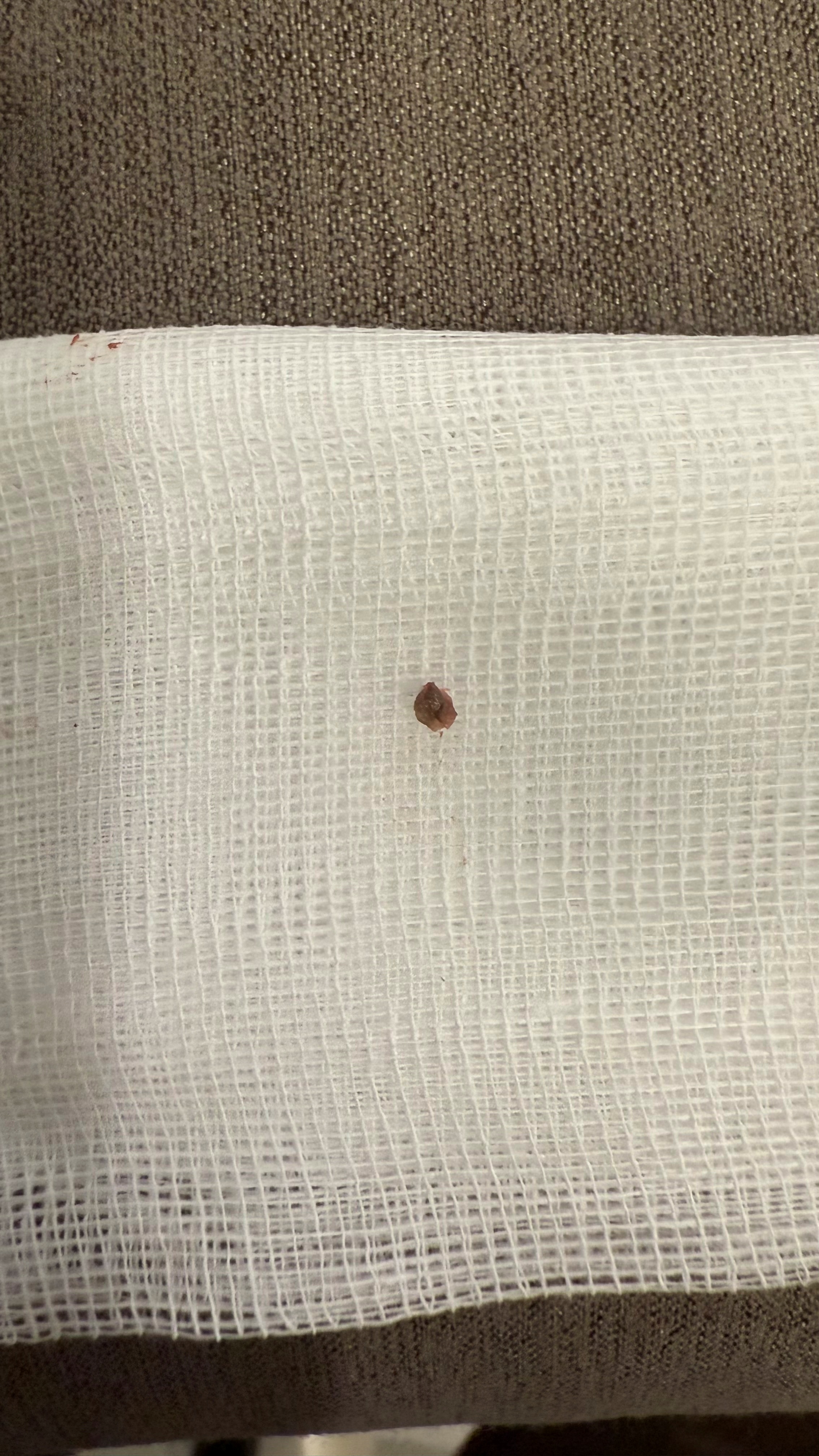 부산점빼기 제거된 점