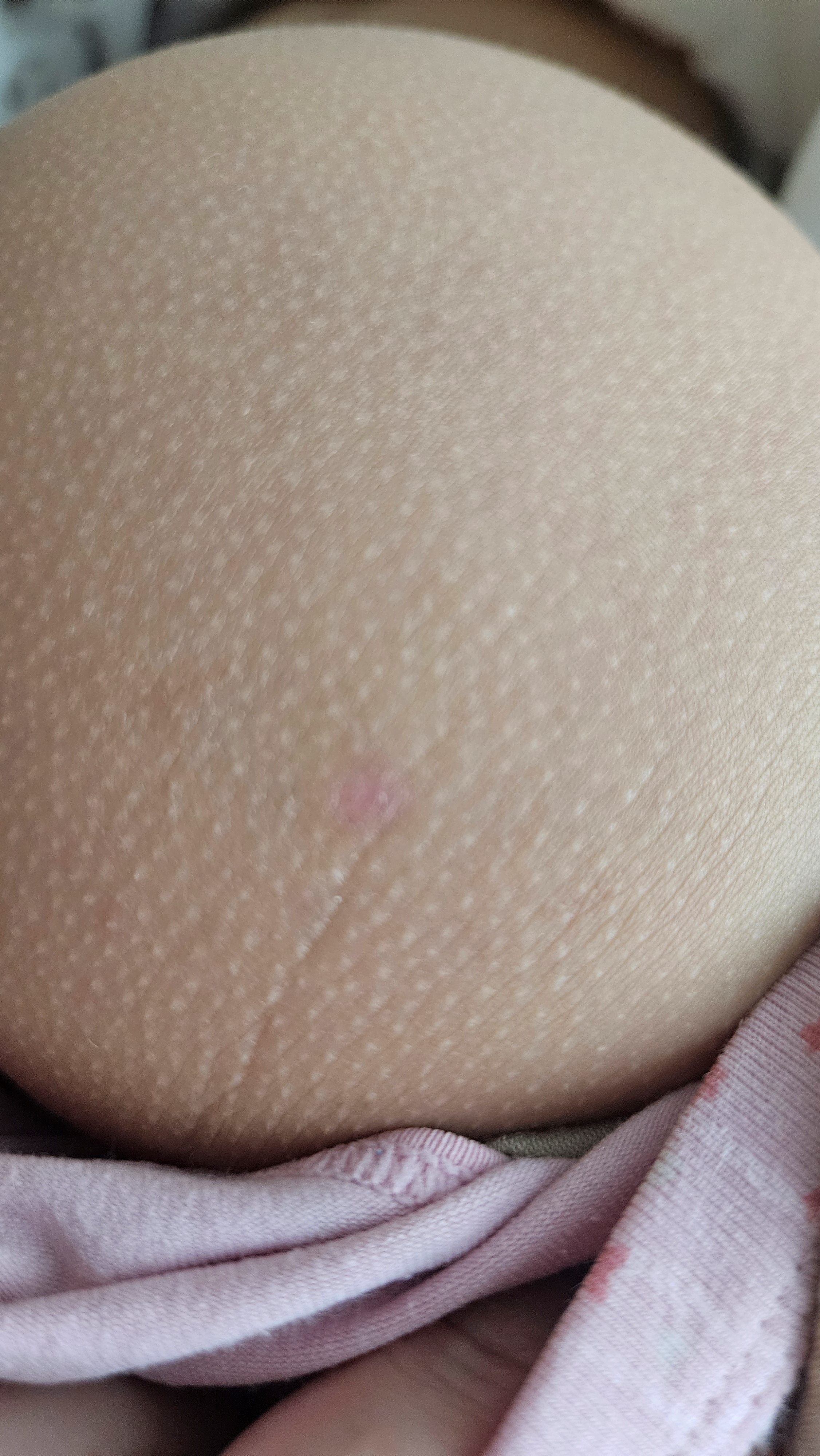 부산점빼기 후 깔끔해진 모습