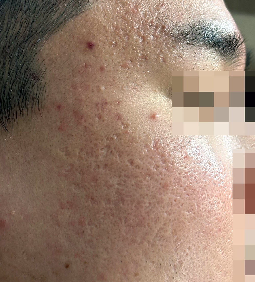 부산흉터치료 전 관자놀이, 볼 패임
