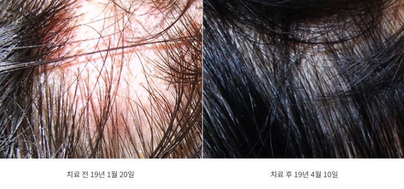 지루성두피염 치료 전후 두피 상태 개선 비교 사진