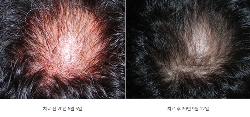 지루성두피염 한방 치료 전후 두피 발적 및 모발 밀도 개선 비교 사진