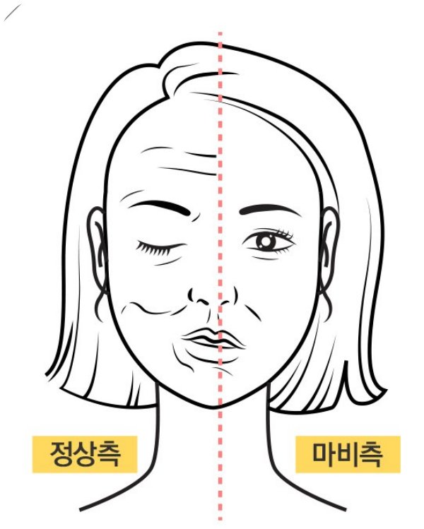 부산구안와사한의원 구안와사 정상측 마비측 비교 도식