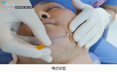 부산구안와사한의원 매선요법 안면마비 치료