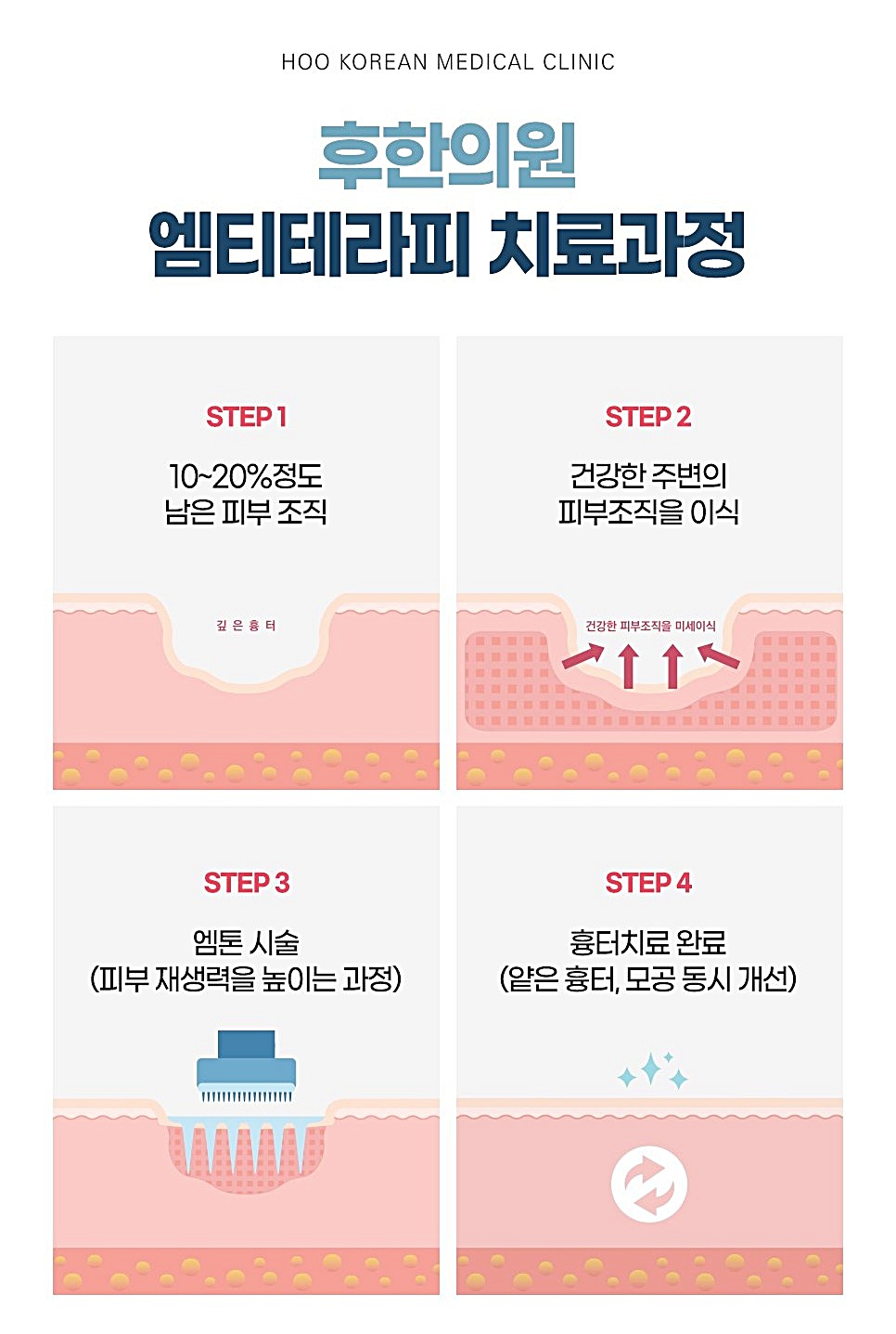 후한의원 엠티테라피 치료과정 4단계 다이어그램