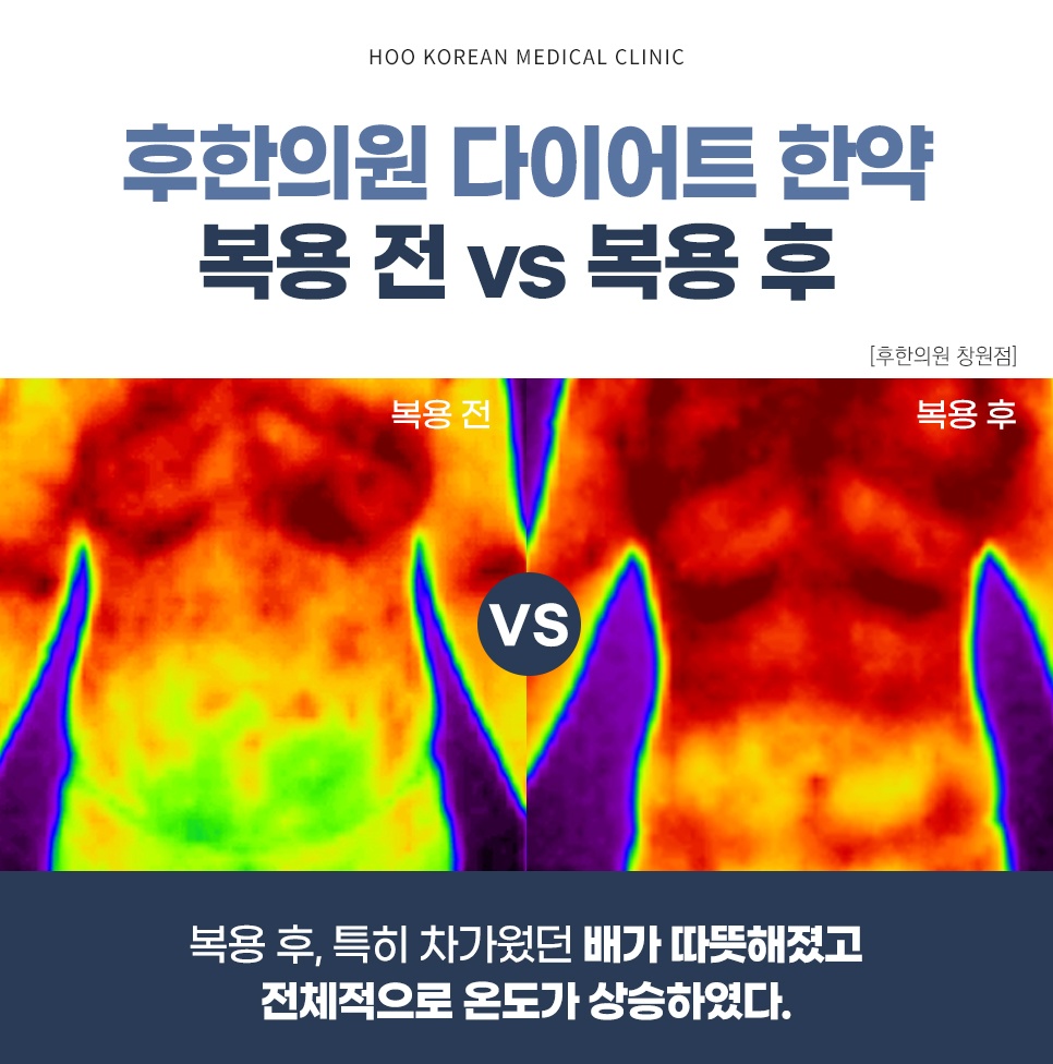 후한의원 다이어트 한약 복용 전후 체온 변화 적외선 체열 검사 비교