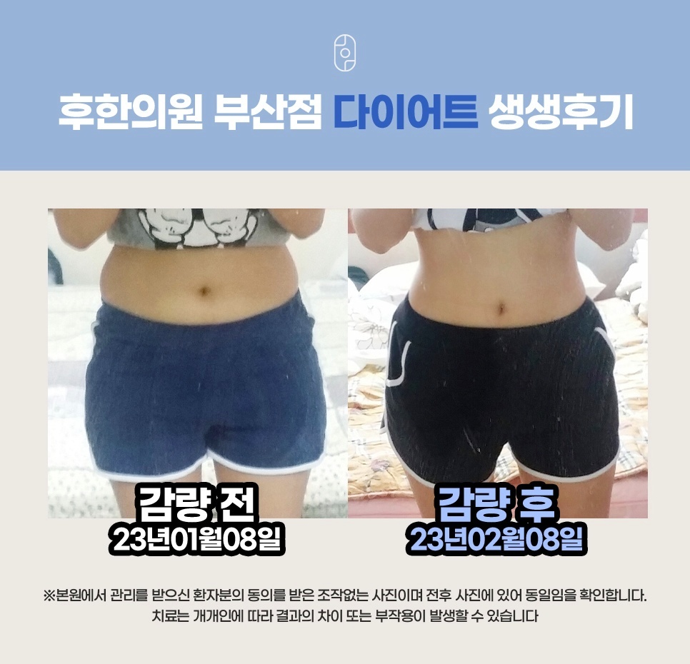 후한의원 부산점 다이어트 전후 체형 및 복부 변화 생생후기 사진