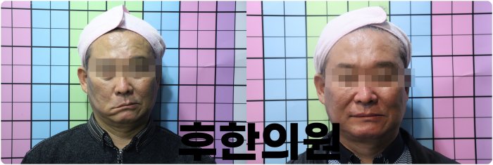 부산구안와사 치료 전후 비교 - 안면마비 완전 회복