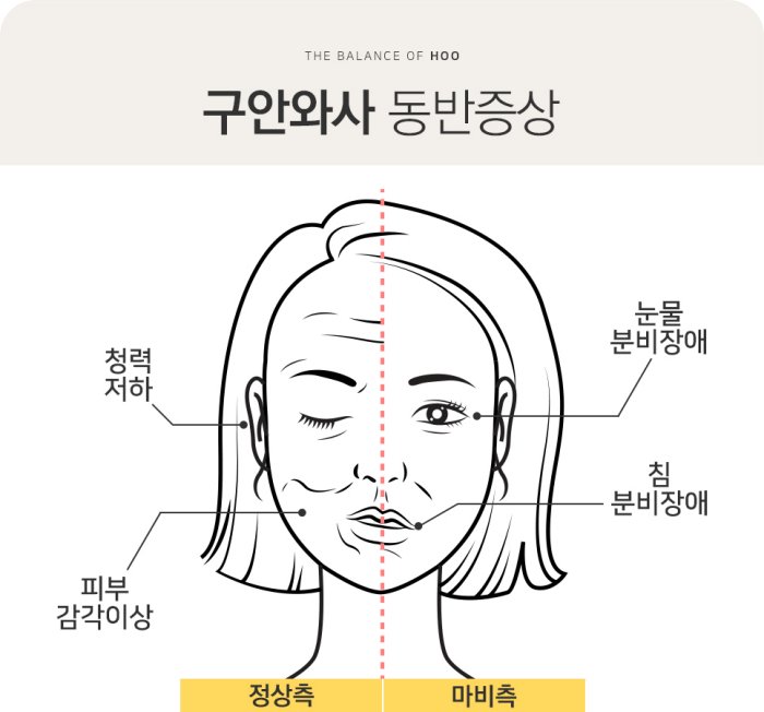 구안와사와 정상 얼굴 비교 - 이마 주름 차이로 중풍 구분