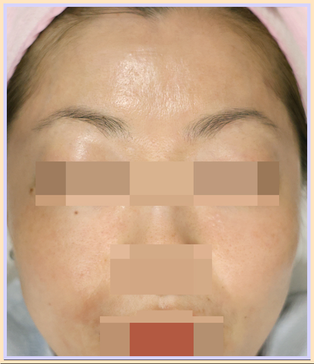 주사피부염 치료 후
