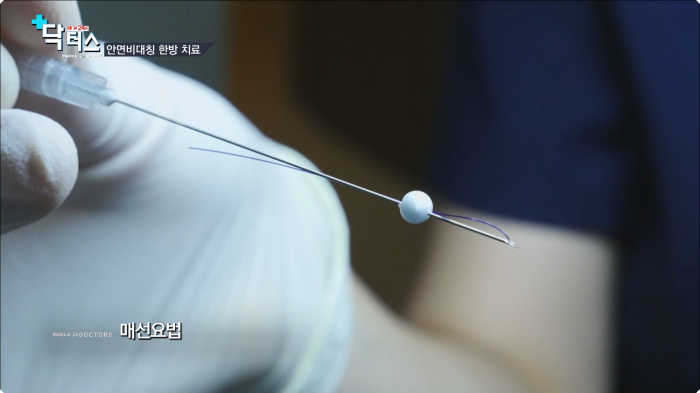 매선요법 녹는 실이 장착된 시술 바늘 클로즈업