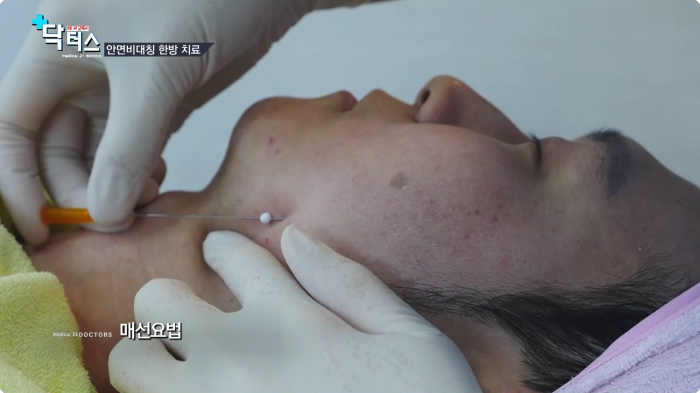 부산안면비대칭교정 매선요법 시술 장면 - 턱 부위 실 삽입