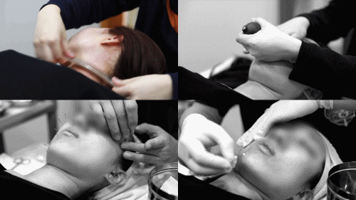  안면비대칭 교정을 위한 턱과 관자놀이 근육 이완 치료 과정