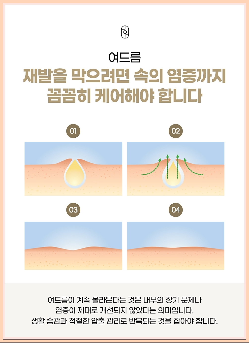재발 방지의 중요성