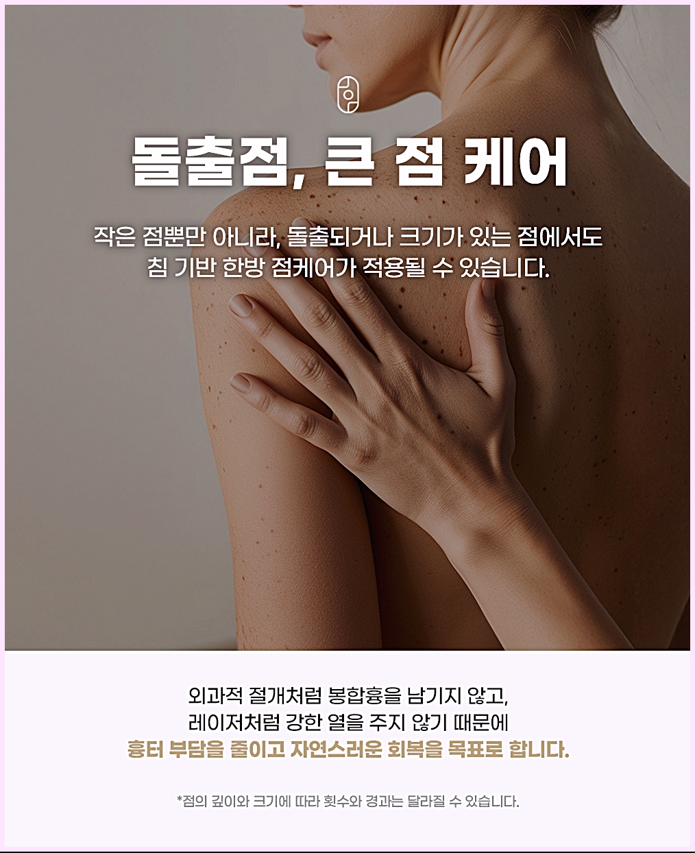 부산점제거 작은 점뿐 아니라 돌출되거나 큰 점에도 침 기반 한방 점케어를 적용