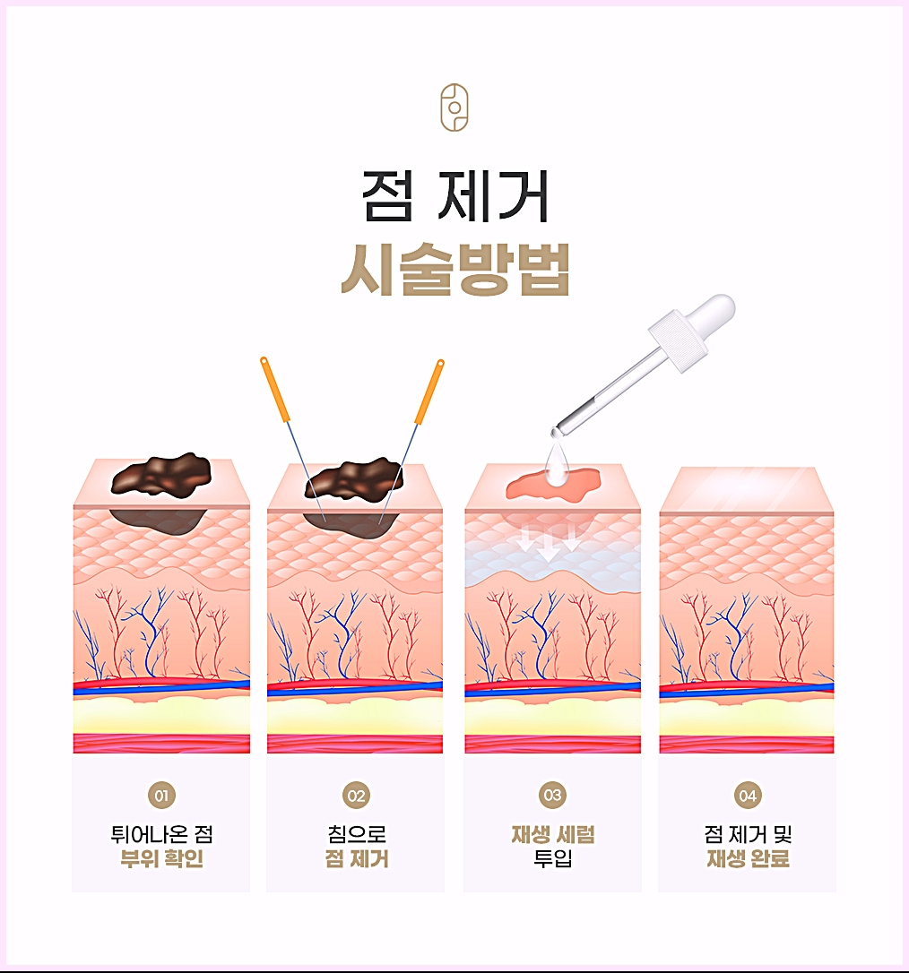 튀어나온 점 부위 확인, 침으로 점 제거, 재생 세럼 투입, 제거 및 재생 완료로 이어지는 점제거 시술 4단계