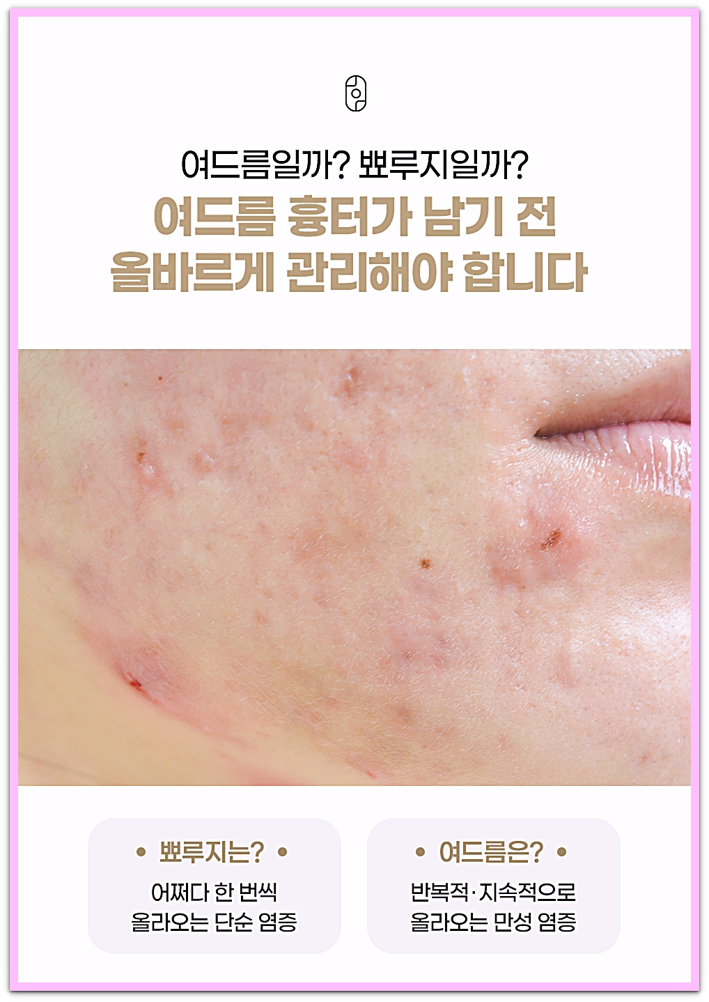 부산여드름피부과 여드름과 뾰루지의 차이를 설명