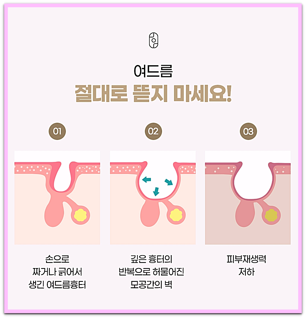 손으로 짜거나 긁어서 생긴 여드름 흉터와 모공 사이 벽이 허물어지는 과정