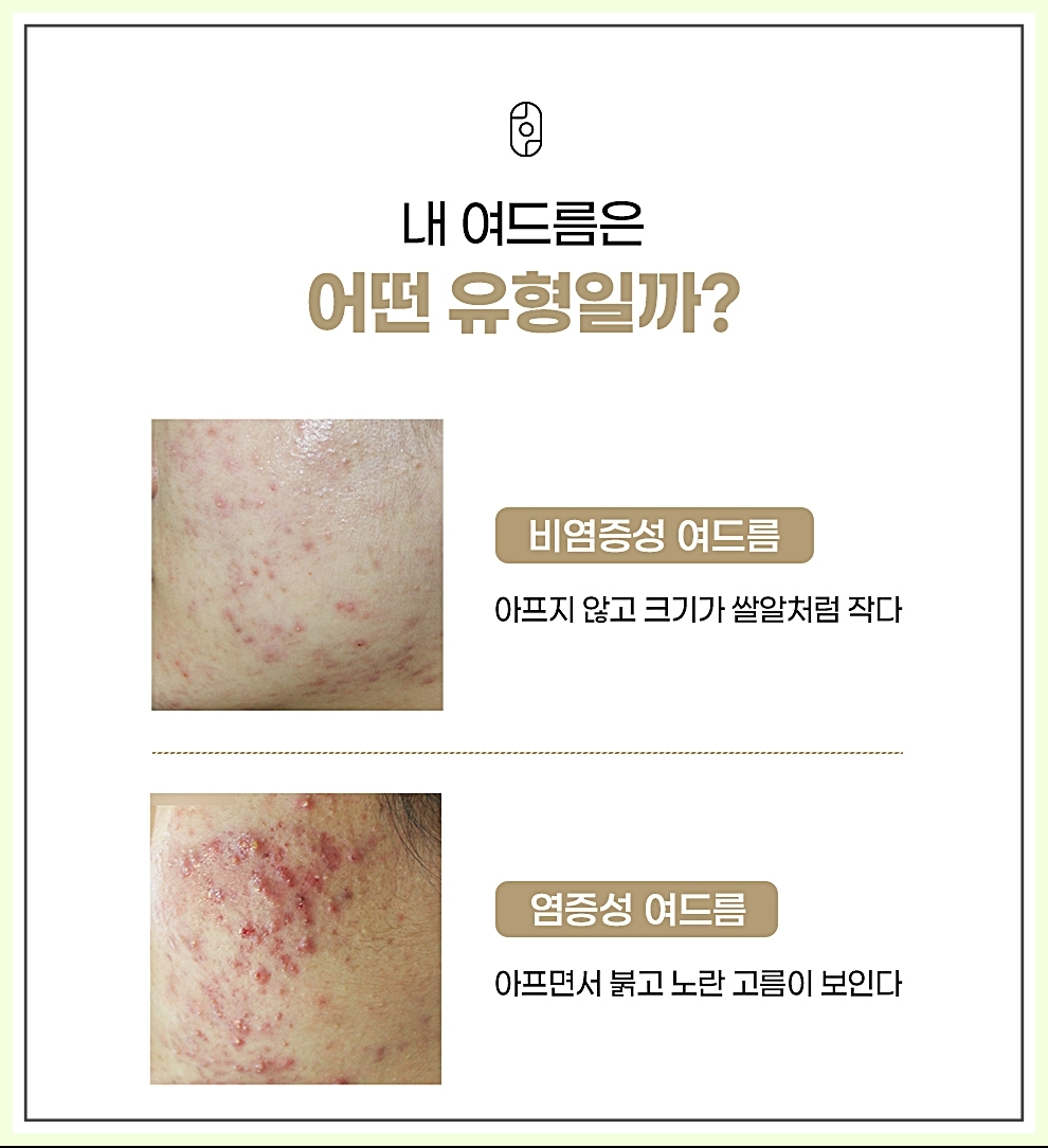 부산여드름압출 여드름 유형 종류