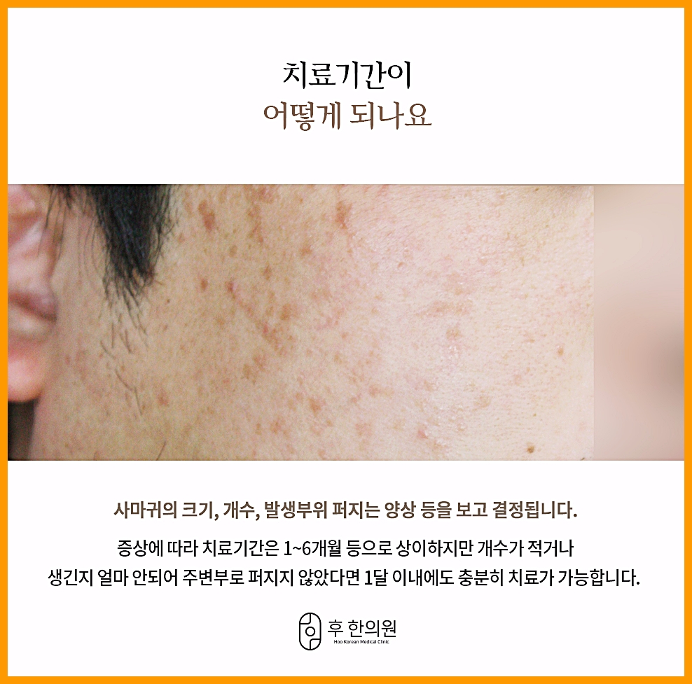 부산 편평사마귀 치료 기간을 정하는 볼 위 병변 클로즈업