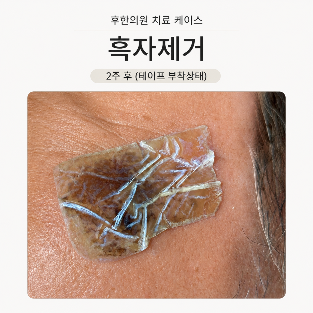 흑자제거 치료 2주 후 얼굴 측면의 피부 상태