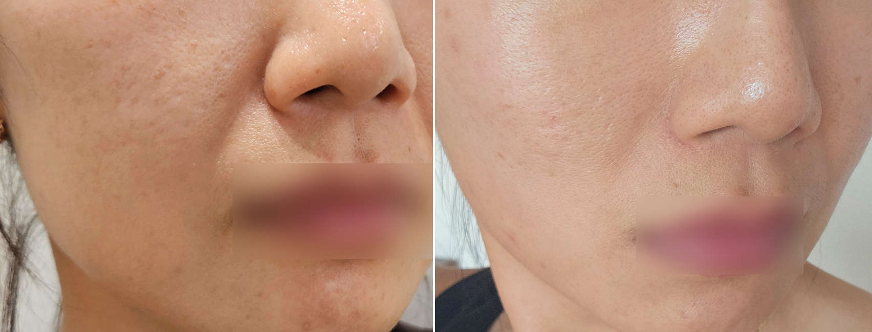 중안면 처짐 팔자주름 실리프팅 전후